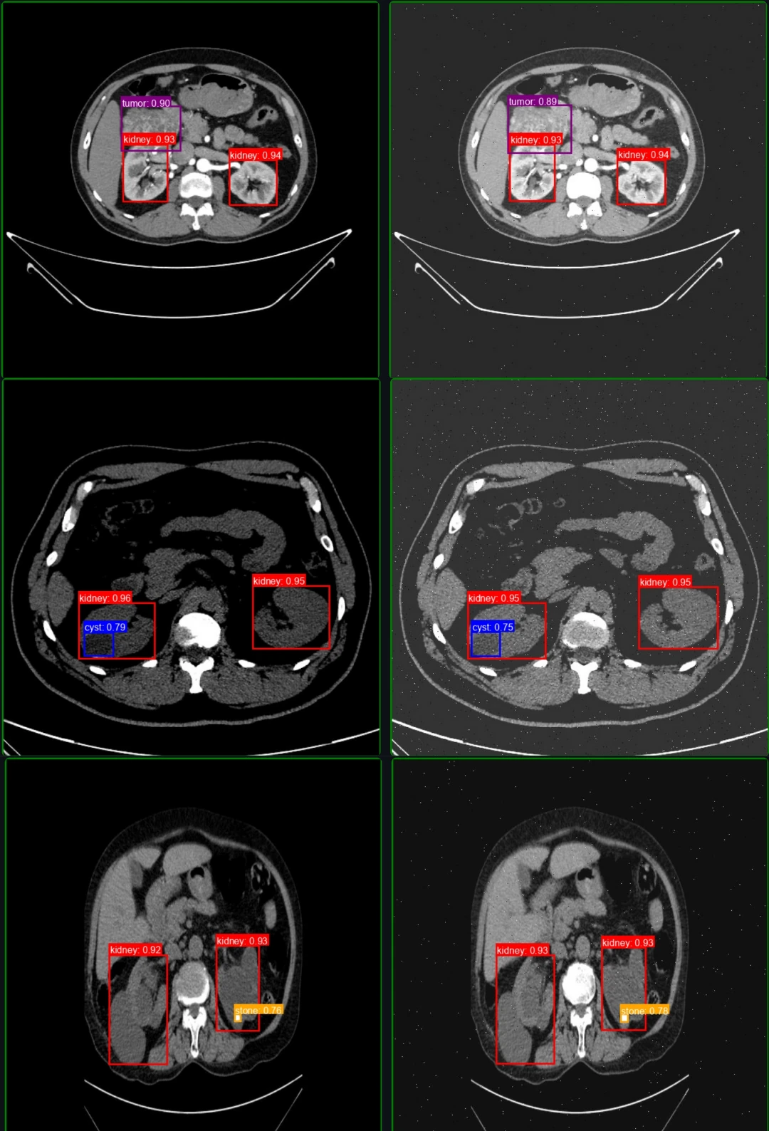 Six axial CT slices of the abdomen with detection boxes around kidney cysts, stones, and tumors
